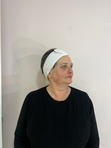 Paciente depois da harmonização facial - lado esquerdo